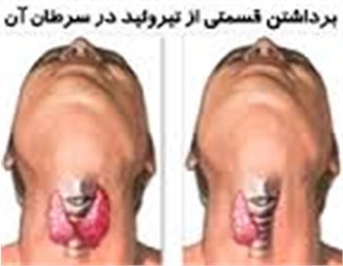 افزایش سرطان تیروئید در ایران